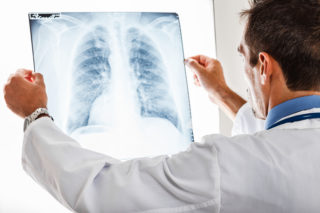 Lung Carcinoid Tumors