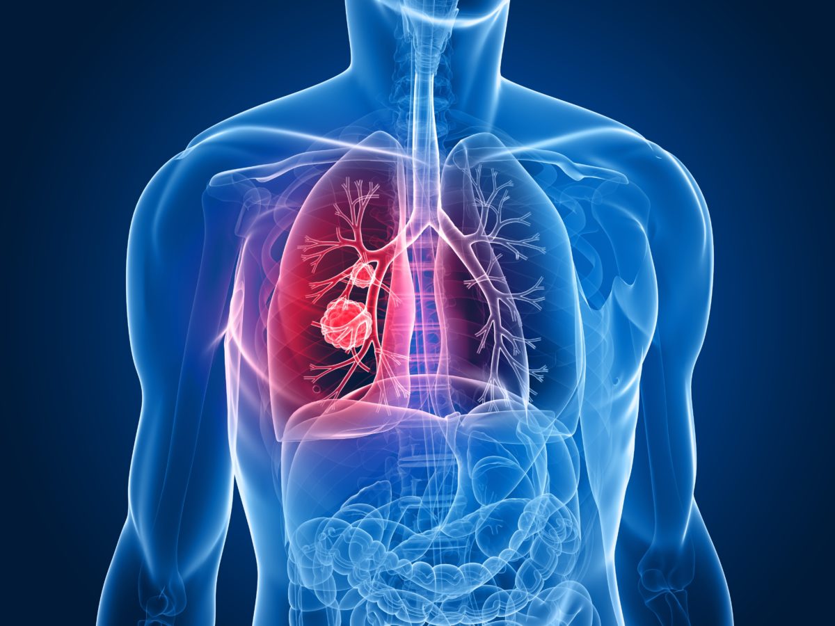 bigstock-lung-tumor-7170754-1200x900.jpg